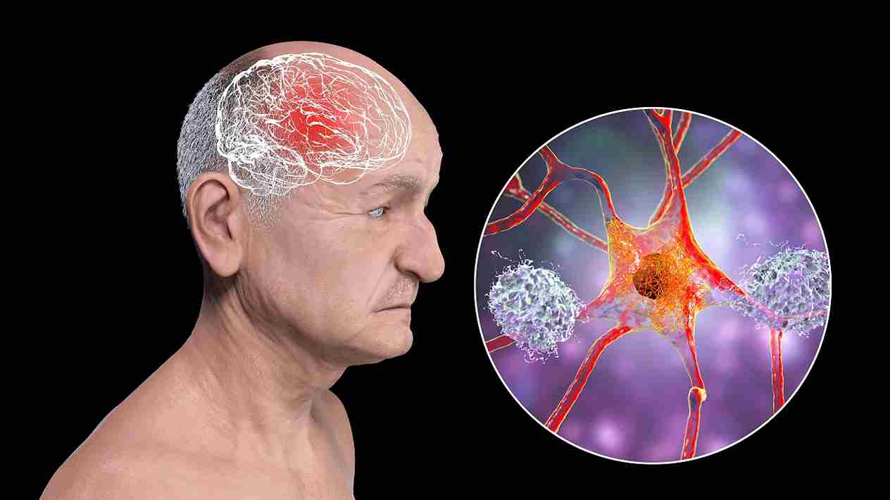 What is Atipical Parkinsonism? – What is Atypical Parkinsonism in Hindi